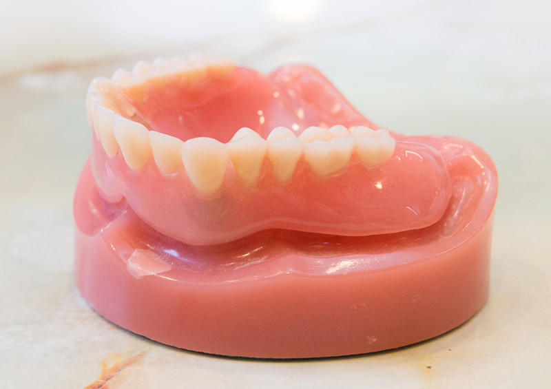 マグネット固定式義歯